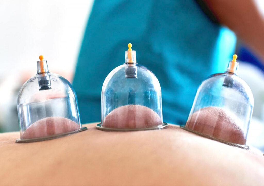 Hijama Cupping Therapie